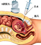 羊水穿刺