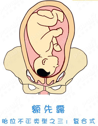 胎位不正怎么办？纠正胎位的正方法（图）