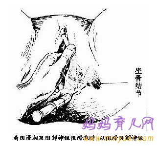 顺产侧切伤口护理方法及注意事项（图片）