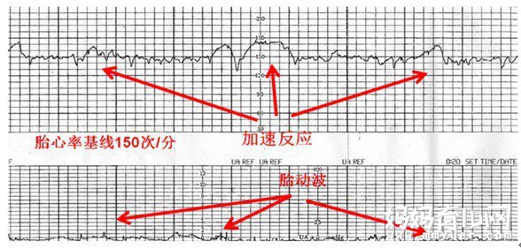 不知道胎心监护图怎么看？教你简单几步看懂胎心监护图