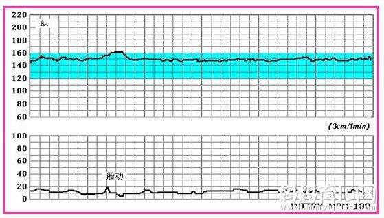不知道胎心监护图怎么看？教你简单几步看懂胎心监护图