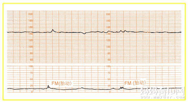不知道胎心监护图怎么看？教你简单几步看懂胎心监护图