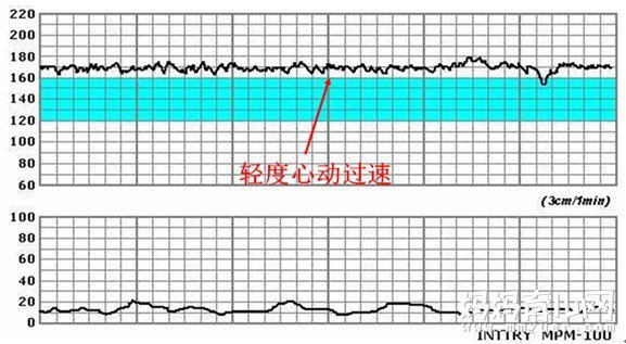 不知道胎心监护图怎么看？教你简单几步看懂胎心监护图