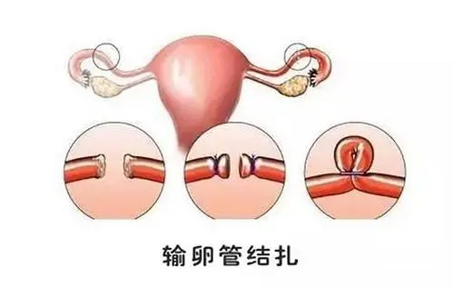 结扎手术还能恢复生育吗