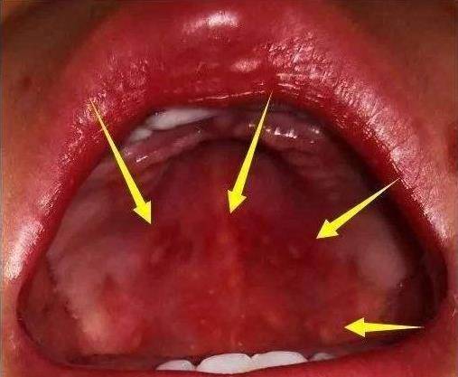 儿童咽喉疱疹初期症状有哪些