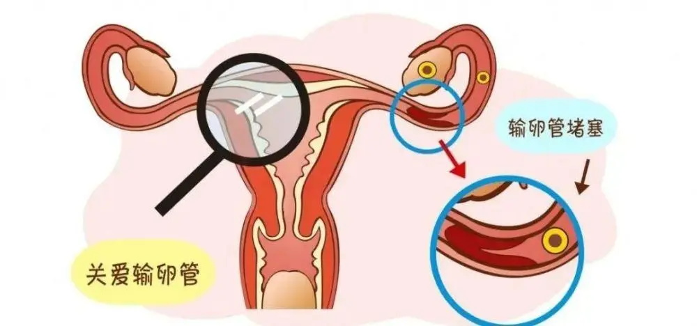 输卵管自测9种方法，教你怎么在家自测输卵管是否通畅