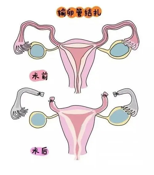 结扎后怎样才能再怀孕 结扎十多年了还可以接上吗？