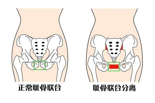 孕妇几个月开始耻骨痛