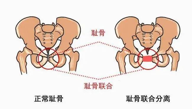 孕妇耻骨痛是怎么回事 怀孕耻骨疼是那个位置