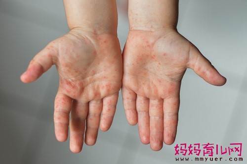 如何判断是不是手足口病