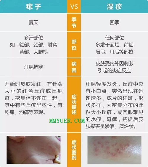 湿疹和痱子有什么区别？一张图教你区别湿疹和痱子